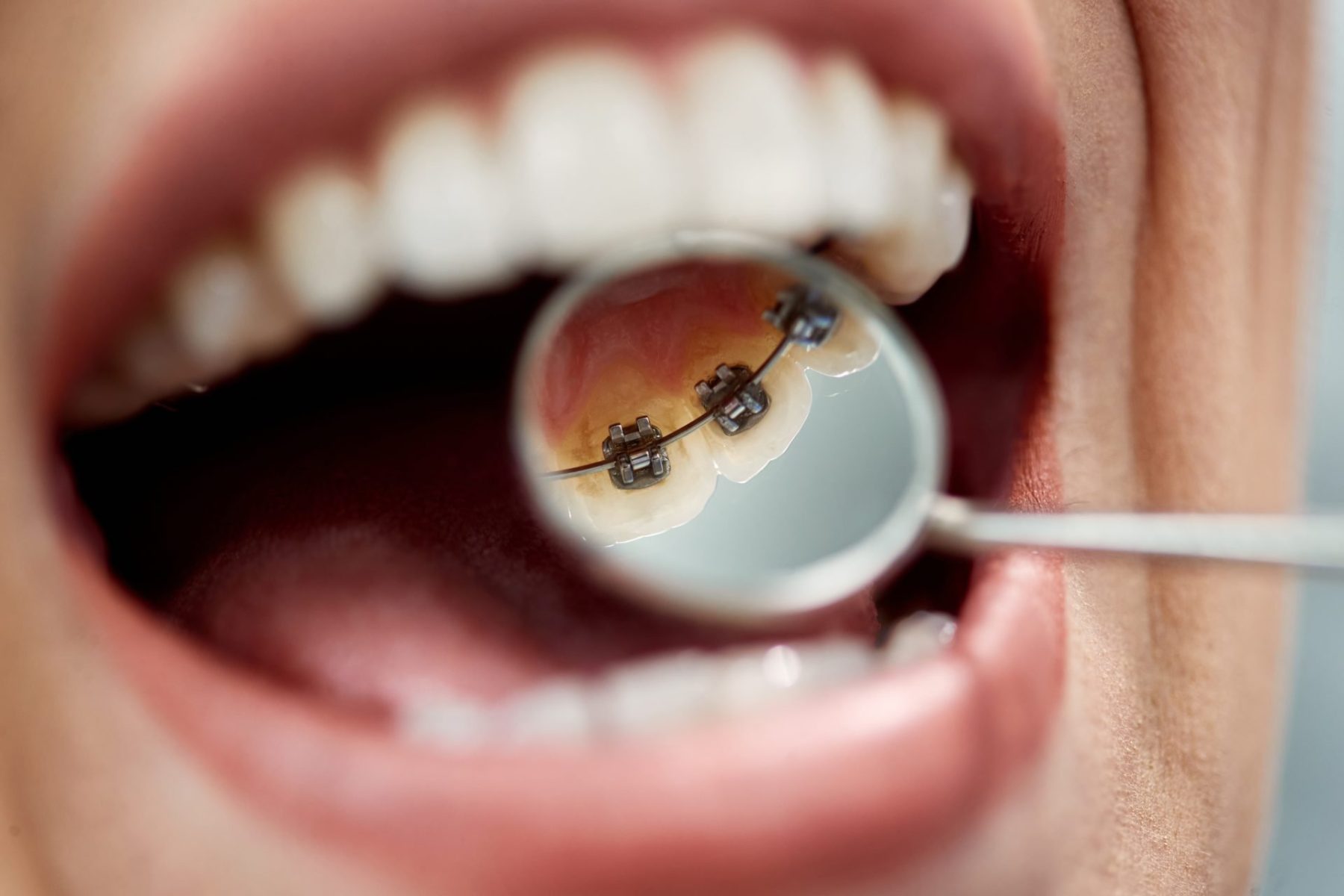 close-up-of-woman-having-lingual-braces-check-up-b-2023-11-27-05-00-26-utc