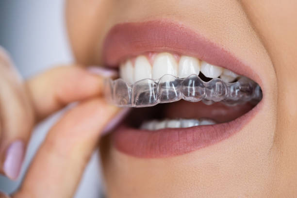 The Power of Invisalign: Advantages of Discreet and Effective Orthodontics