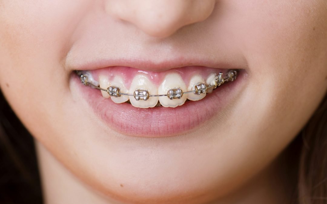 Straightening Your Smile: A Comprehensive Guide to Adult Orthodontic Treatments