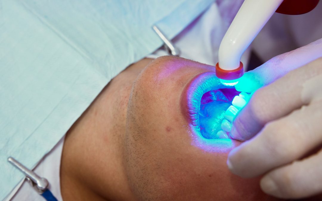 Teeth Whitening Options: Achieve a Dazzling Smile with Professional and Effective Treatments
