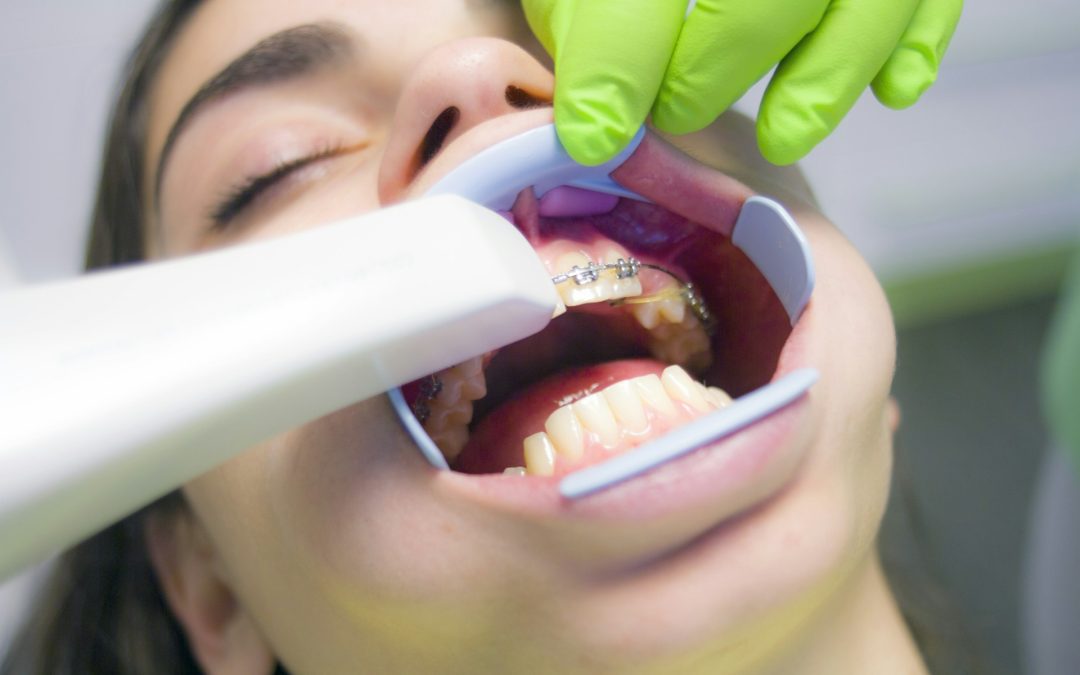 Clear Aligners vs Traditional Braces: Choosing the Right Solution for Your Smile
