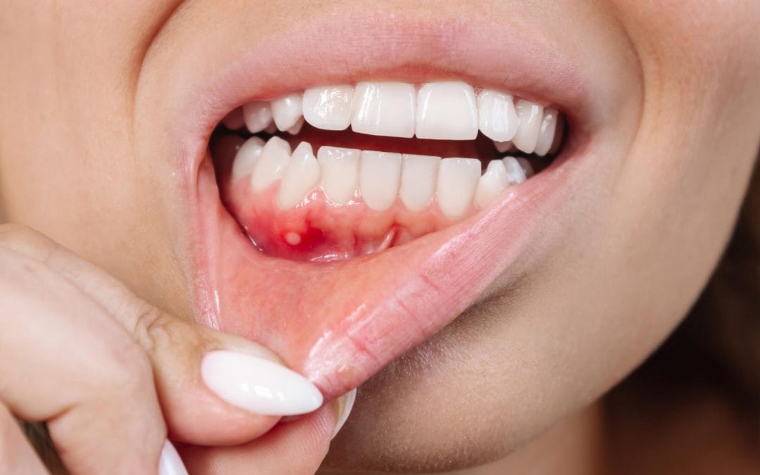 How to Prevent Gum Disease