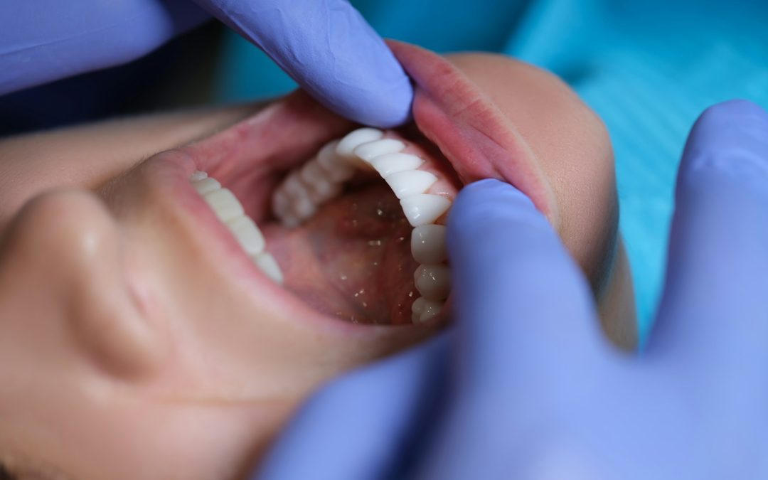 How to Maintain Your Composite Bonding: Dos and Don’ts