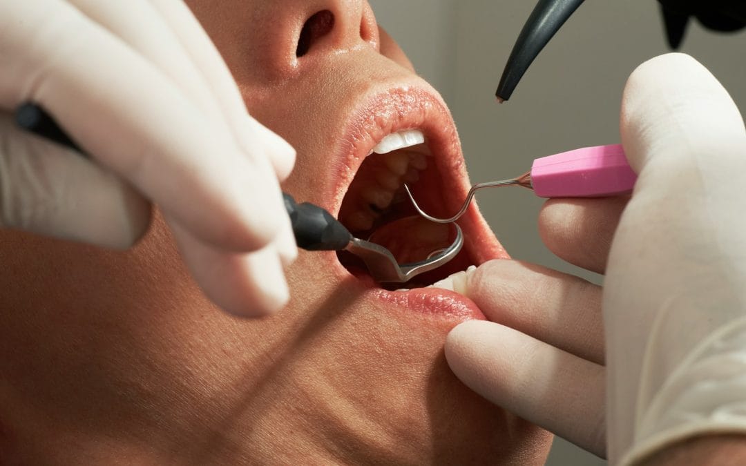 How to Avoid Common Dental Implant Mistakes