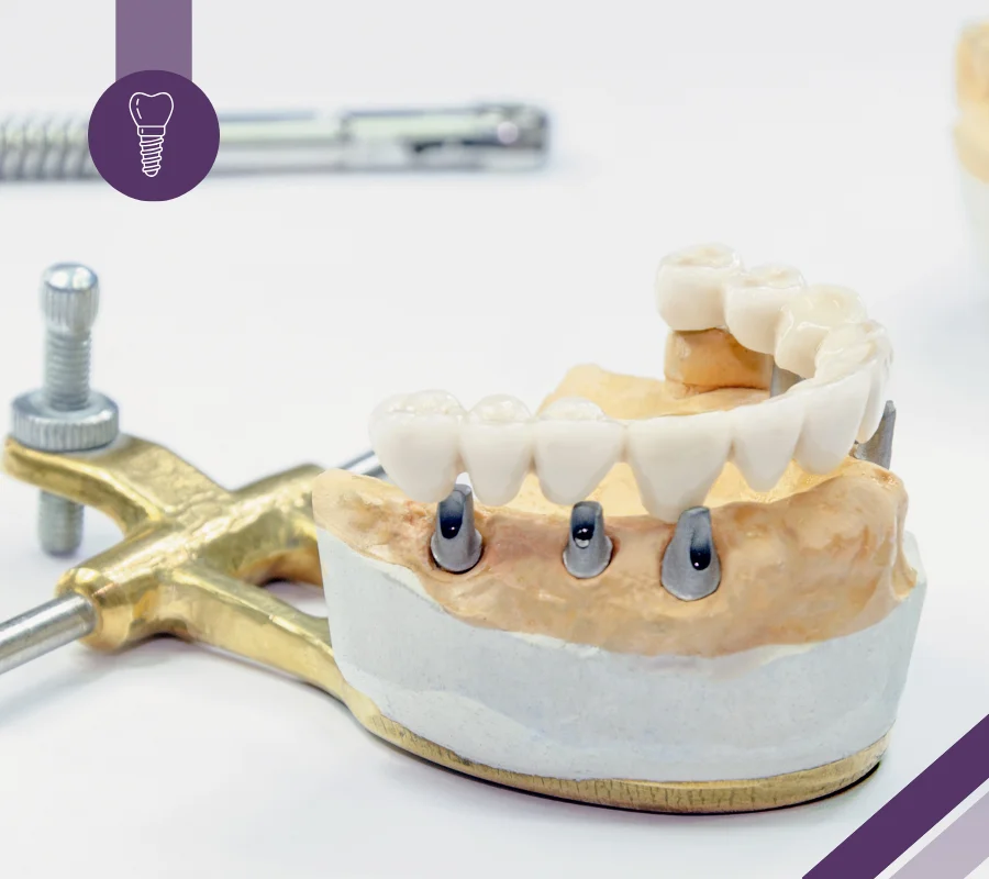 full arch implants model