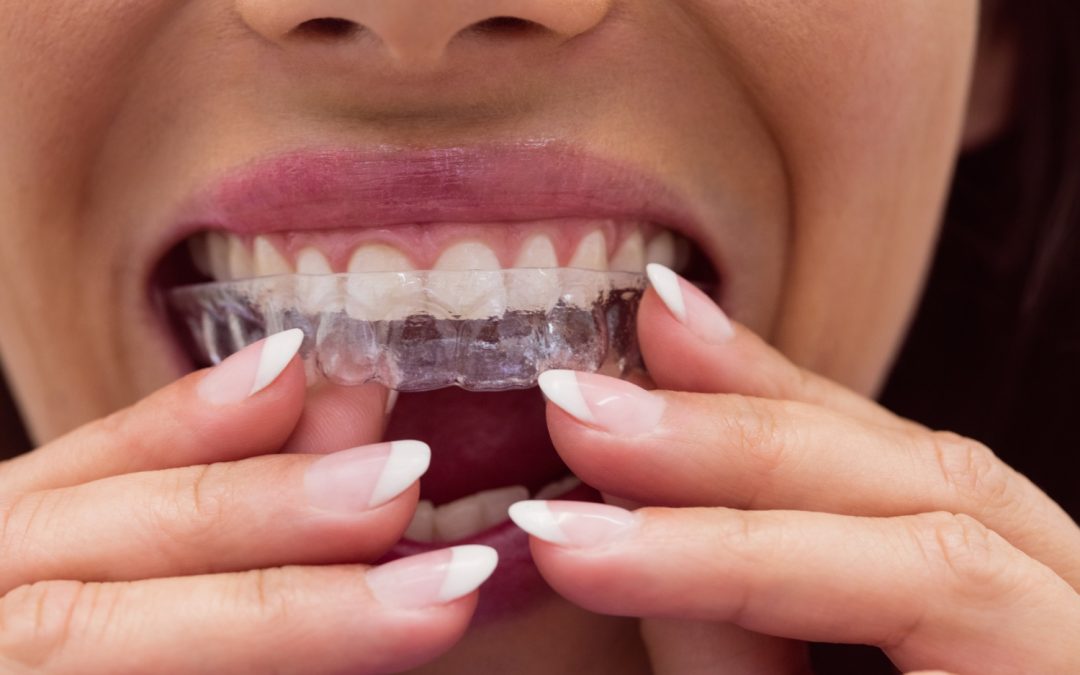 Essential Tips for Taking Care of Your Invisalign