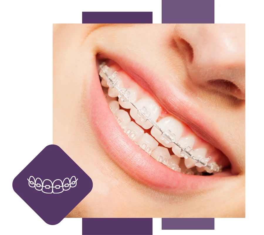 lady smiling with dental braces