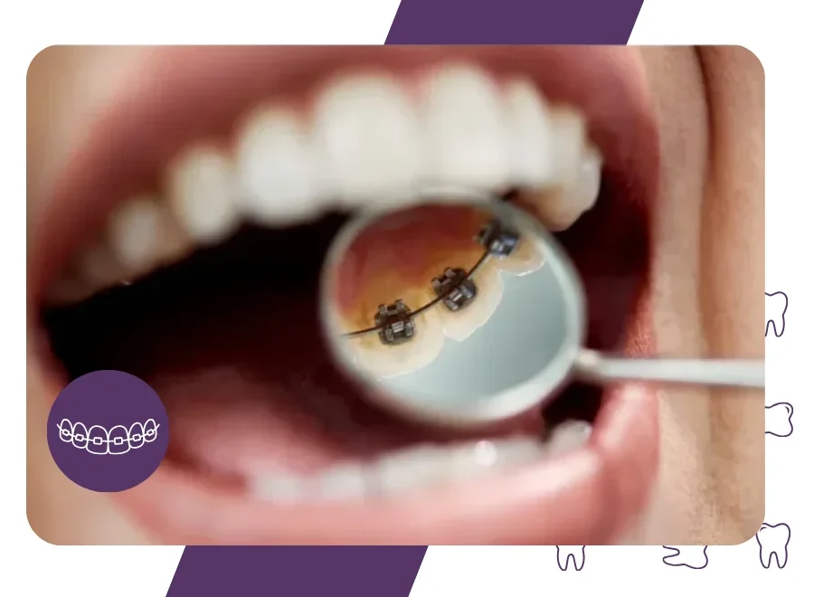 Lingual Braces