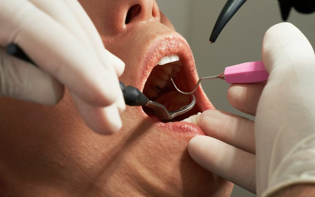 Why Choose Dental Implants in Chesham: Key Benefits Explained