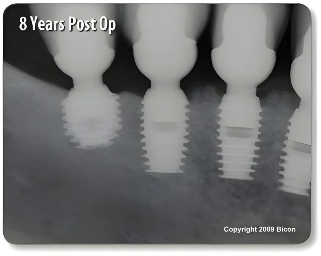 short_dental_implants