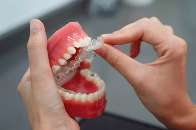 How to Choose the Best Invisalign Provider