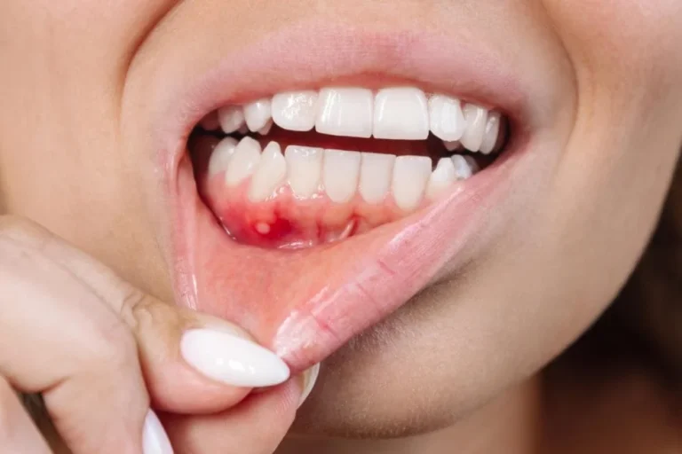 How to Prevent Gum Disease